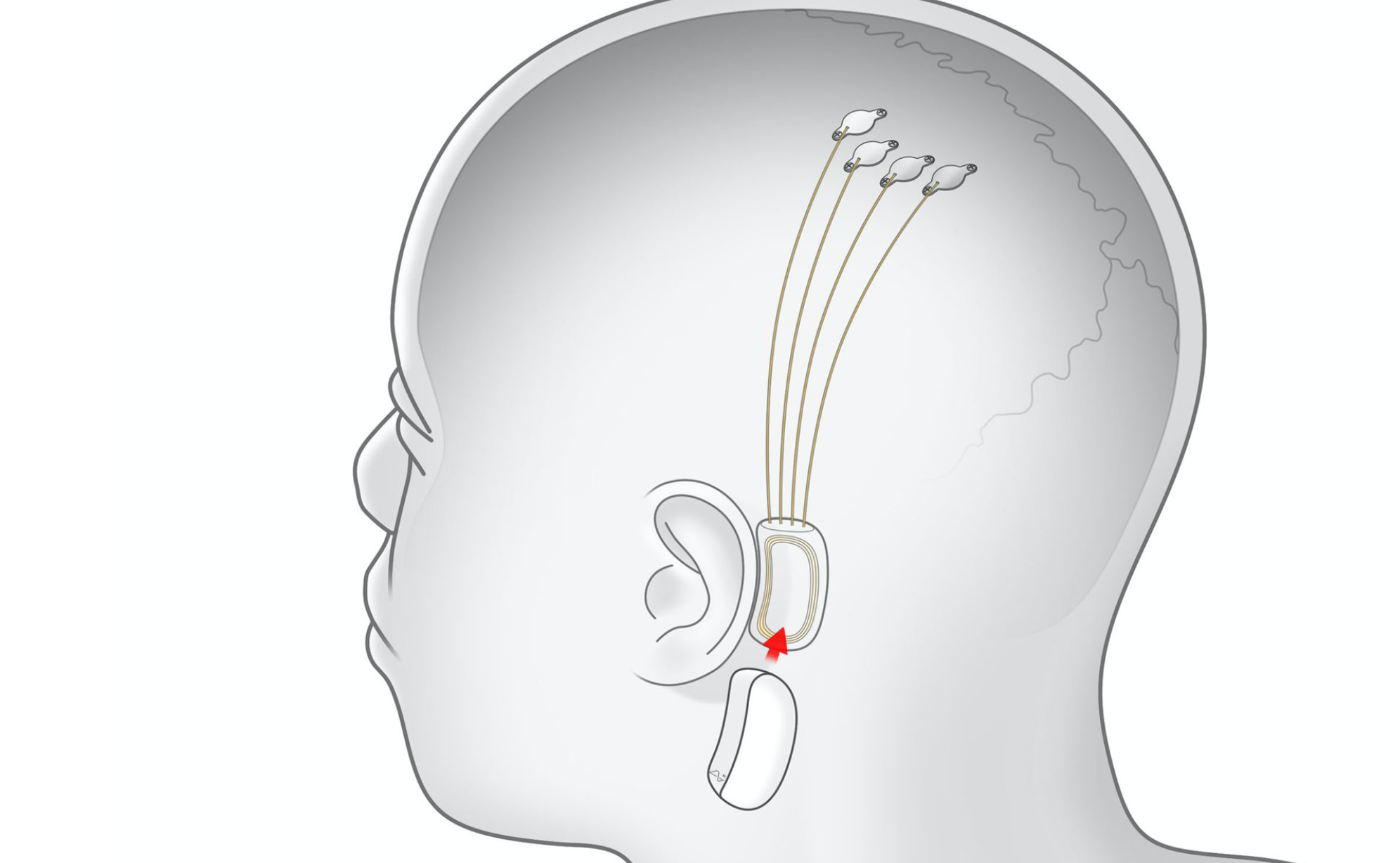 Илон Масктің Neuralink жобасы жіп импланттарын ұсынды