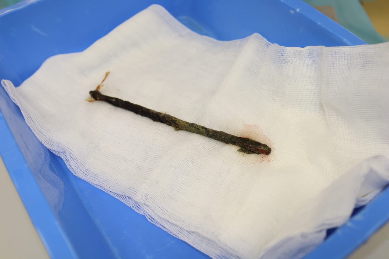 Хирургтар ер адамның асқазанынан 25 см арматура алды