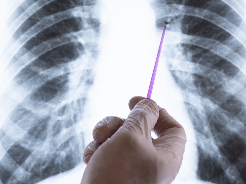 Алматыда туберкулезбен күрес айы басталады