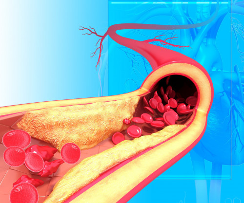 Атеросклероздың алдын алуға болады – Кардиолог дәрігер