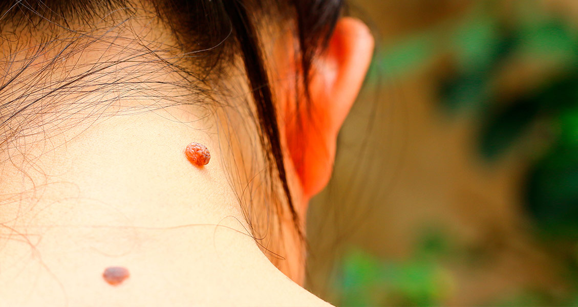 Қал астындағы қатер