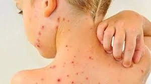 Жұқпалы дерт күшейіп тұр