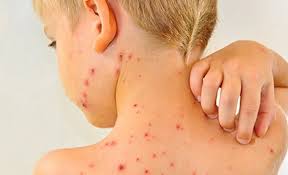 Енді қызылшаға қарсы вакцина міндетті: Астана ауруханаларына бала қабылдау ережесі өзгерді