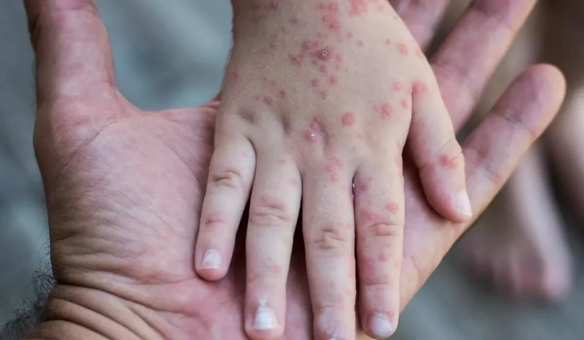 Атырауда жүздеген адамның қызылша жұқтырғаны хабарланды