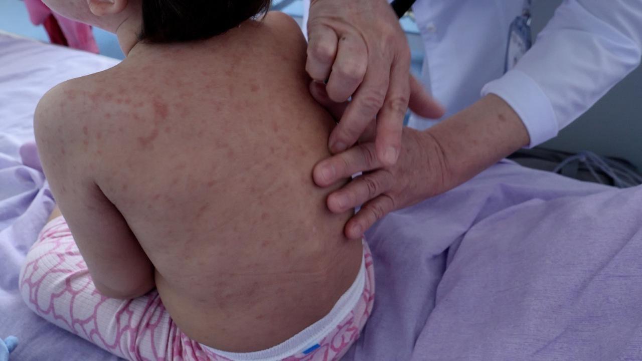 Қызылша жұқтырған балалар көбейген: Дәрігерлер ата-аналарға үндеу жасады